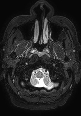 File:Accessory middle cerebral artery (Radiopaedia 73114-83828 Axial T2 219).jpg