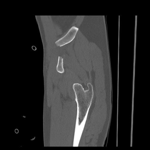 Acetabular and ilial fractures (Radiopaedia 59084-66378 Sagittal bone window 13).jpg