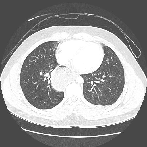 File:Achalasia (Radiopaedia 52507-58417 Axial lung window 41).jpg