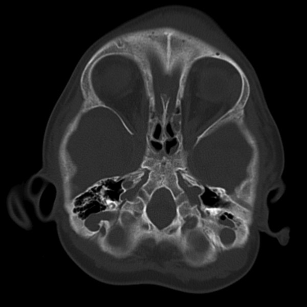 File:Achondroplasia (Radiopaedia 5867-7444 Axial bone window 1).jpg