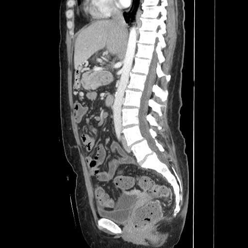 Acinar cell carcinoma of the pancreas (Radiopaedia 75442-86669 Sagittal C+ portal venous phase 96).jpg