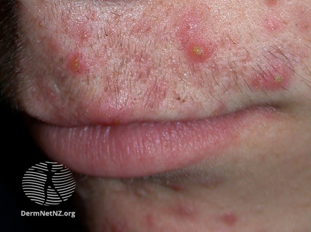 File:Acne with pustules. (DermNet NZ acne-187-v2).jpg
