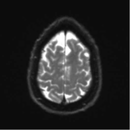 Acoustic schwannoma (Radiopaedia 55729-62281 E 24).png