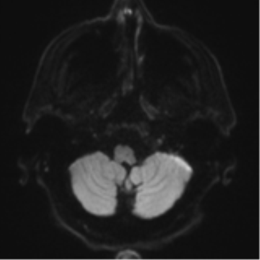 Acoustic schwannoma (Radiopaedia 55729-62281 E 29).png