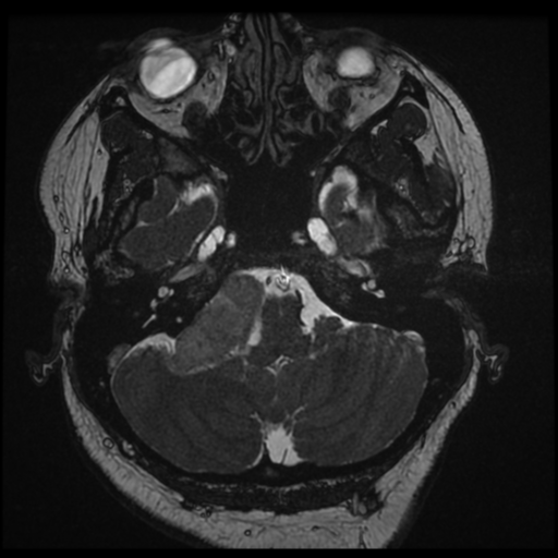 Acoustic schwannoma (Radiopaedia 57574-64536 Axial T2 20).png