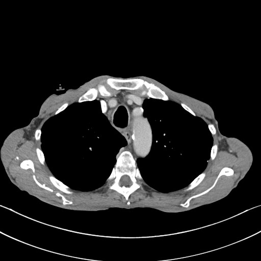 File:Acquired tracheoesophageal fistula (Radiopaedia 57747-65042 Axial C+ portal venous phase 23).jpg
