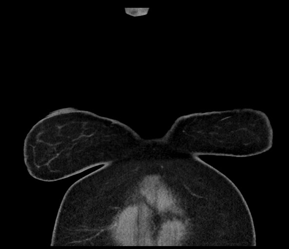 Acromioclavicular joint cyst (Radiopaedia 58455-65610 Coronal C+ arterial phase 15).jpg
