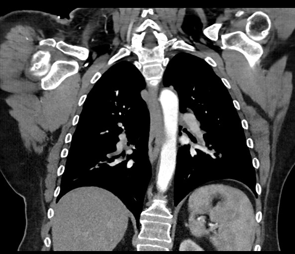 Acromioclavicular joint cyst (Radiopaedia 58455-65610 Coronal C+ arterial phase 94).jpg