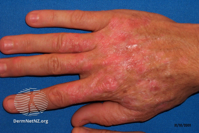 File:Actinic keratoses affecting the hands (DermNet NZ lesions-ak-hands-443).jpg