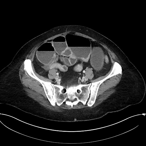 Active Crohn disease (Radiopaedia 59394-66750 Axial C+ portal venous phase 54).jpg