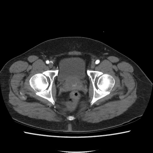 Active colonic bleed on CT (Radiopaedia 49765-55025 Axial C+ arterial phase 79).jpg