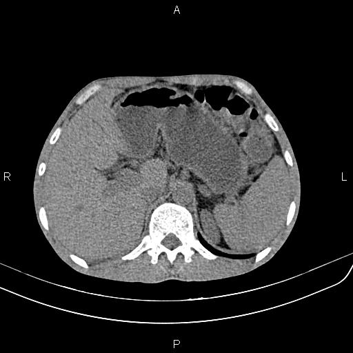 Active crohn disease (Radiopaedia 87133-103397 Axial non-contrast 24).jpg