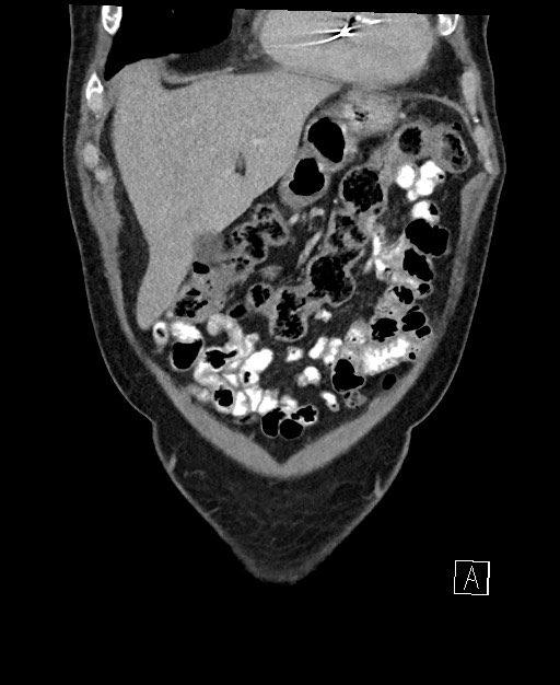 Active lower gastrointestinal bleeding - diverticular (Radiopaedia 61203-69106 Coronal C+ portal venous phase 30).jpg