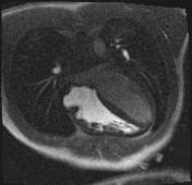 File:Active right ventricular cardiac sarcoidosis (Radiopaedia 55596-62100 Axial Dynamic perfusion scan MOCO 55).jpg