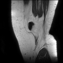 Acute-on-chronic transient lateral patellar dislocation with trochlear dysplasia (Radiopaedia 84099-99349 Sagittal PD 19).jpg