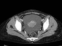 Acute Budd-Chiari syndrome (Radiopaedia 60858-68638 A 266).jpg