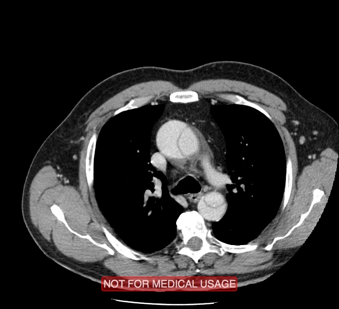 Acute aortic dissection - Stanford type A (Radiopaedia 40661-43285 Axial C+ portal venous phase 12).jpg