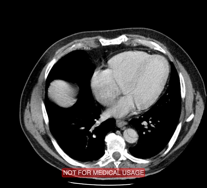 Acute aortic dissection - Stanford type A (Radiopaedia 40661-43285 Axial C+ portal venous phase 39).jpg