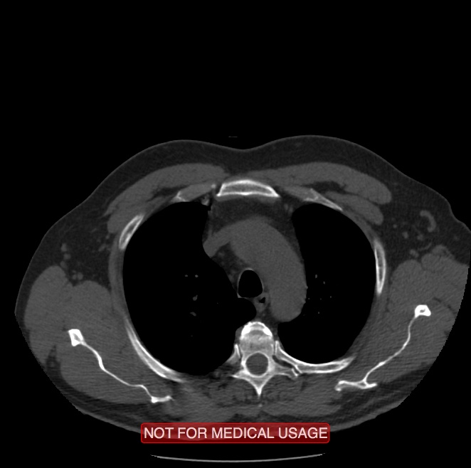 Acute aortic dissection - Stanford type A (Radiopaedia 40661-43285 Axial non-contrast 2).jpg