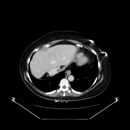 Acute appendicitis, heterotaxy syndrome (Radiopaedia 66884-76202 Axial C+ portal venous phase 19).jpg