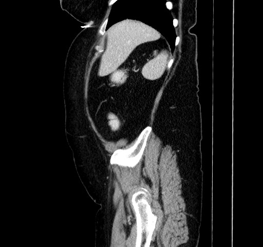 File:Acute appendicitis, heterotaxy syndrome (Radiopaedia 66884-76202 Sagittal C+ portal venous phase 32).jpg