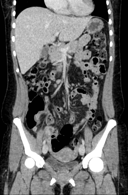 Acute appendicitis (Radiopaedia 22892-22918 Coronal C+ portal venous phase 19).png