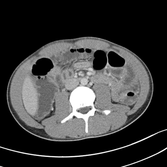 Acute appendicitis (Radiopaedia 32614-33572 Axial C+ portal venous phase 32).jpg