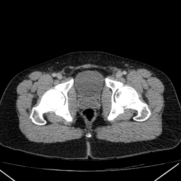 File:Acute appendicitis (Radiopaedia 38255-40270 Axial C+ portal venous phase 109).jpg