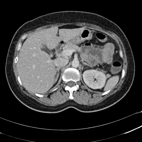 File:Acute appendicitis (Radiopaedia 48792-53822 Axial C+ portal venous phase 33).jpg