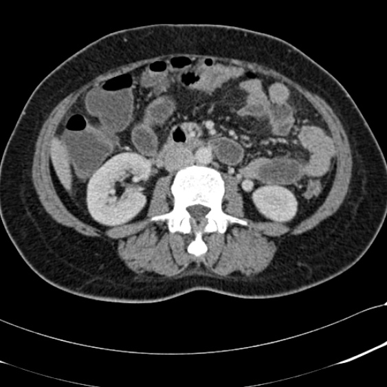 Acute appendicitis (Radiopaedia 48792-53822 Axial C+ portal venous phase 56).jpg