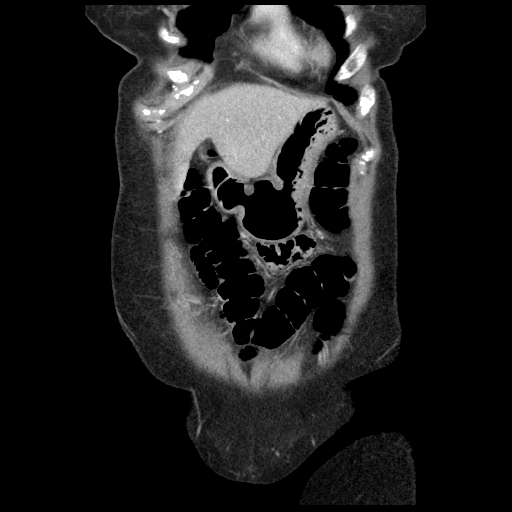Acute appendicitis (Radiopaedia 52672-58589 Coronal C+ portal venous phase 1).jpg