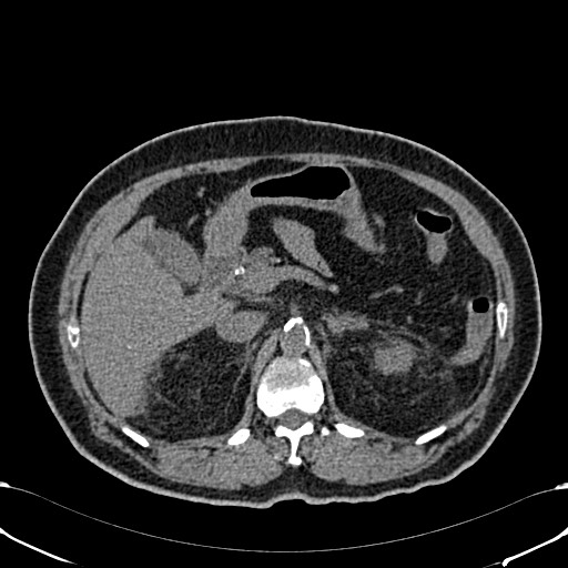 File:Acute appendicitis (Radiopaedia 58627-65818 Axial non-contrast 28).jpg