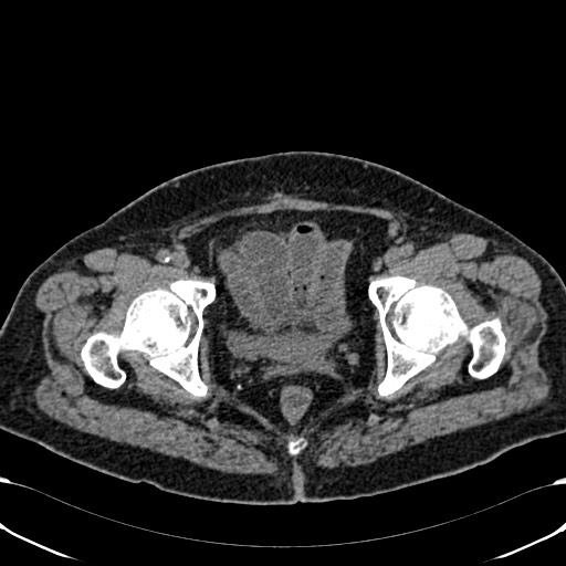 Acute appendicitis (Radiopaedia 58627-65818 Axial non-contrast 83).jpg