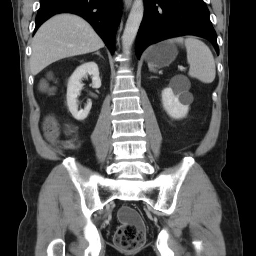 Acute appendicitis (Radiopaedia 66513-75790 Coronal C+ portal venous phase 59).jpg