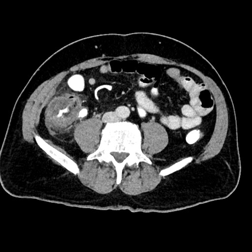 Acute appendicitis (Radiopaedia 77016-88960 Axial C+ portal venous phase 90).jpg