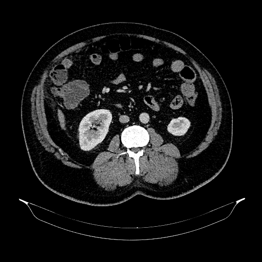 Acute appendicitis (Radiopaedia 79950-93224 Axial C+ portal venous phase 52).jpg