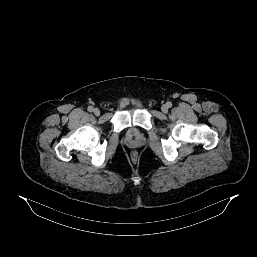 Acute appendicitis (Radiopaedia 79950-93224 Axial non-contrast 99).jpg