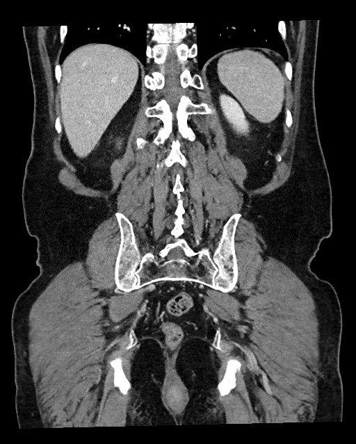 Acute appendicitis - large appendicoliths (Radiopaedia 61805-69820 Coronal C+ portal venous phase 105).jpg