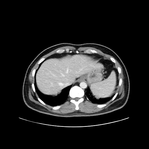 Acute appendicitis and COVID 19 pneumonia (Radiopaedia 76604-88380 Axial C+ portal venous phase 11).jpg