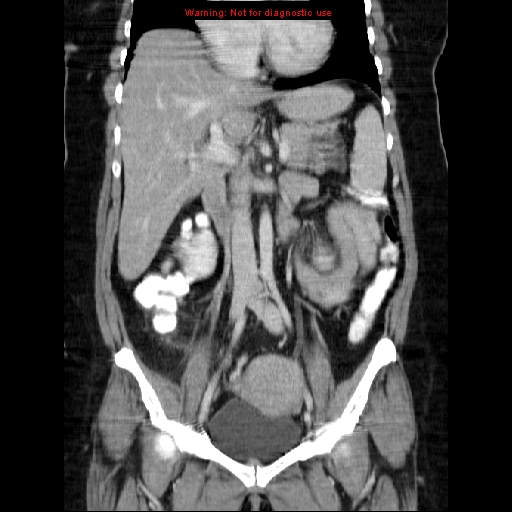 File:Acute appendicitis complicated by ovarian vein thrombophlebitis (Radiopaedia 16172-15851 Coronal C+ portal venous phase 41).jpg