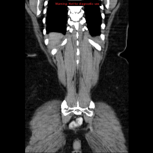 Acute appendicitis complicated by ovarian vein thrombophlebitis (Radiopaedia 16172-15851 Coronal C+ portal venous phase 71).jpg