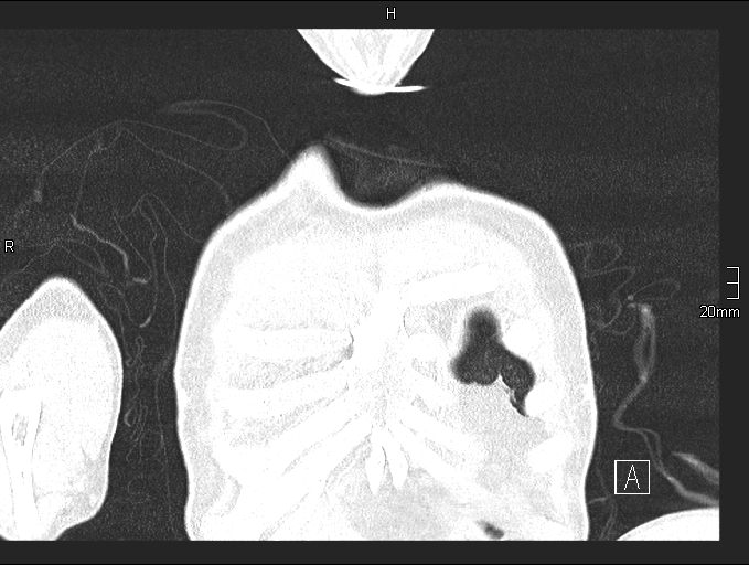 Acute aspiration pneumonitis (Radiopaedia 55642-62166 Coronal lung window 6).jpg