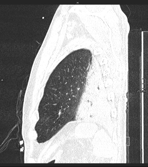 Acute aspiration pneumonitis (Radiopaedia 55642-62166 Sagittal lung window 15).jpg