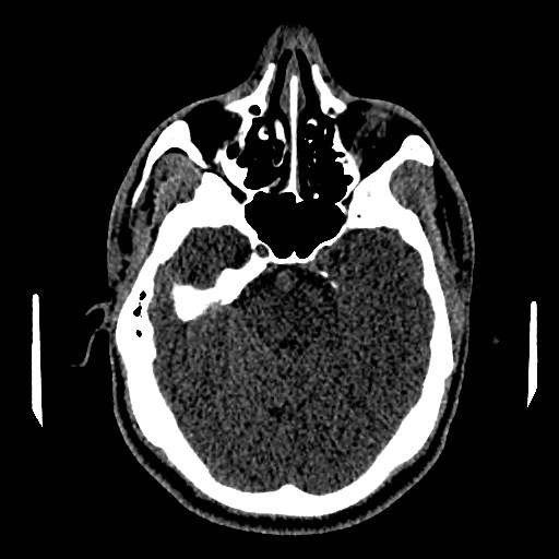 File:Acute basilar artery occlusion (Radiopaedia 43582-46985 Axial non-contrast 66).jpg