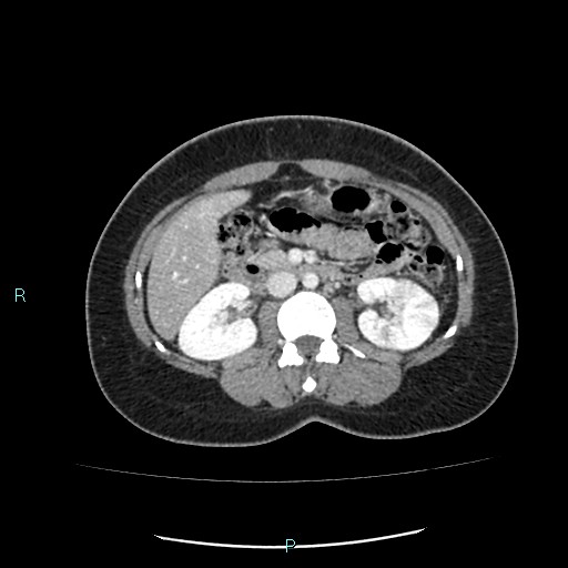 Acute bilateral pyelonephritis (Radiopaedia 37146-38881 Axial C+ portal venous phase 46).jpg