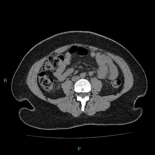 Acute bilateral pyelonephritis (Radiopaedia 37146-38881 Axial non-contrast 61).jpg