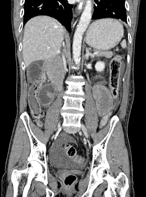 Acute bowel ischemia (Radiopaedia 87695-104114 Coronal C+ portal venous phase 233).jpg