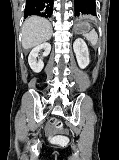 Acute bowel ischemia (Radiopaedia 87695-104114 Coronal C+ portal venous phase 286).jpg