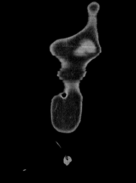 Acute bowel ischemia (Radiopaedia 87695-104114 Coronal C+ portal venous phase 54).jpg