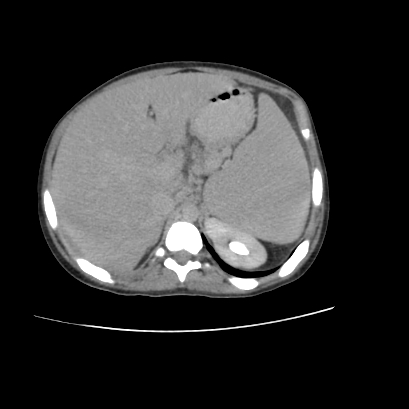 File:Acute calculous cholecystitis in patient with osteopetrosis (Radiopaedia 77871-90159 Axial C+ delayed 7).jpg